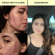 Rituel Complet Anti-Acné - Peau Nette & Confiance Retrouvée