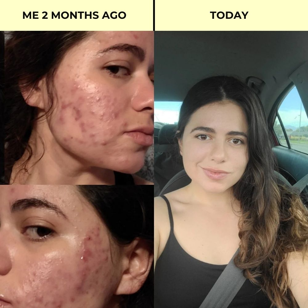 Complete Anti-Acne Ritual – Clear, Blemish-Free Skin