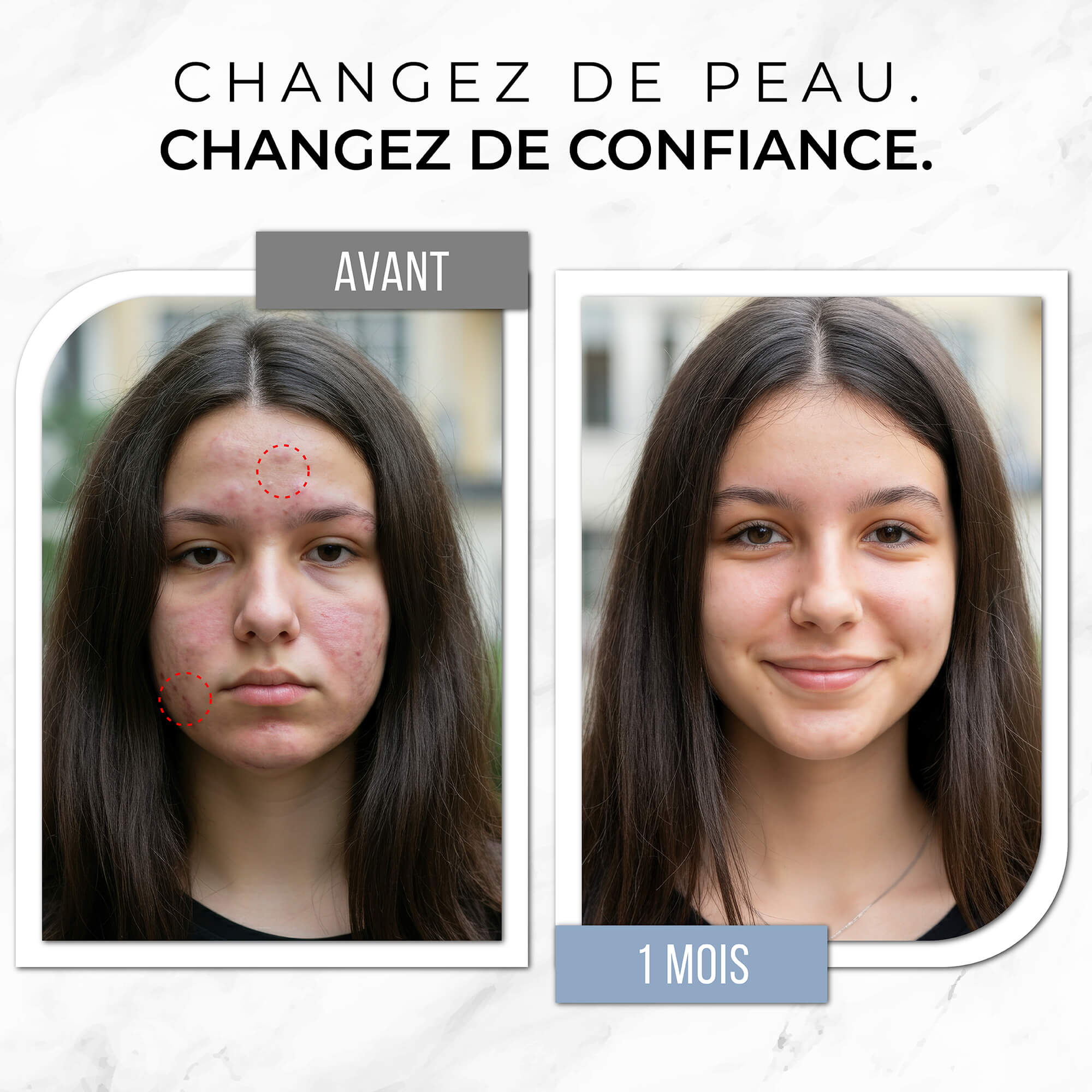 Rituel Complet Anti-Acné - Peau Nette & Confiance Retrouvée