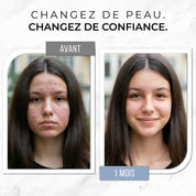 Complete Anti-Acne Ritual - Clear Skin &amp; Restored Confidence